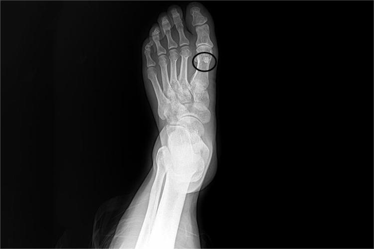 长软骨瘤正常严重吗.