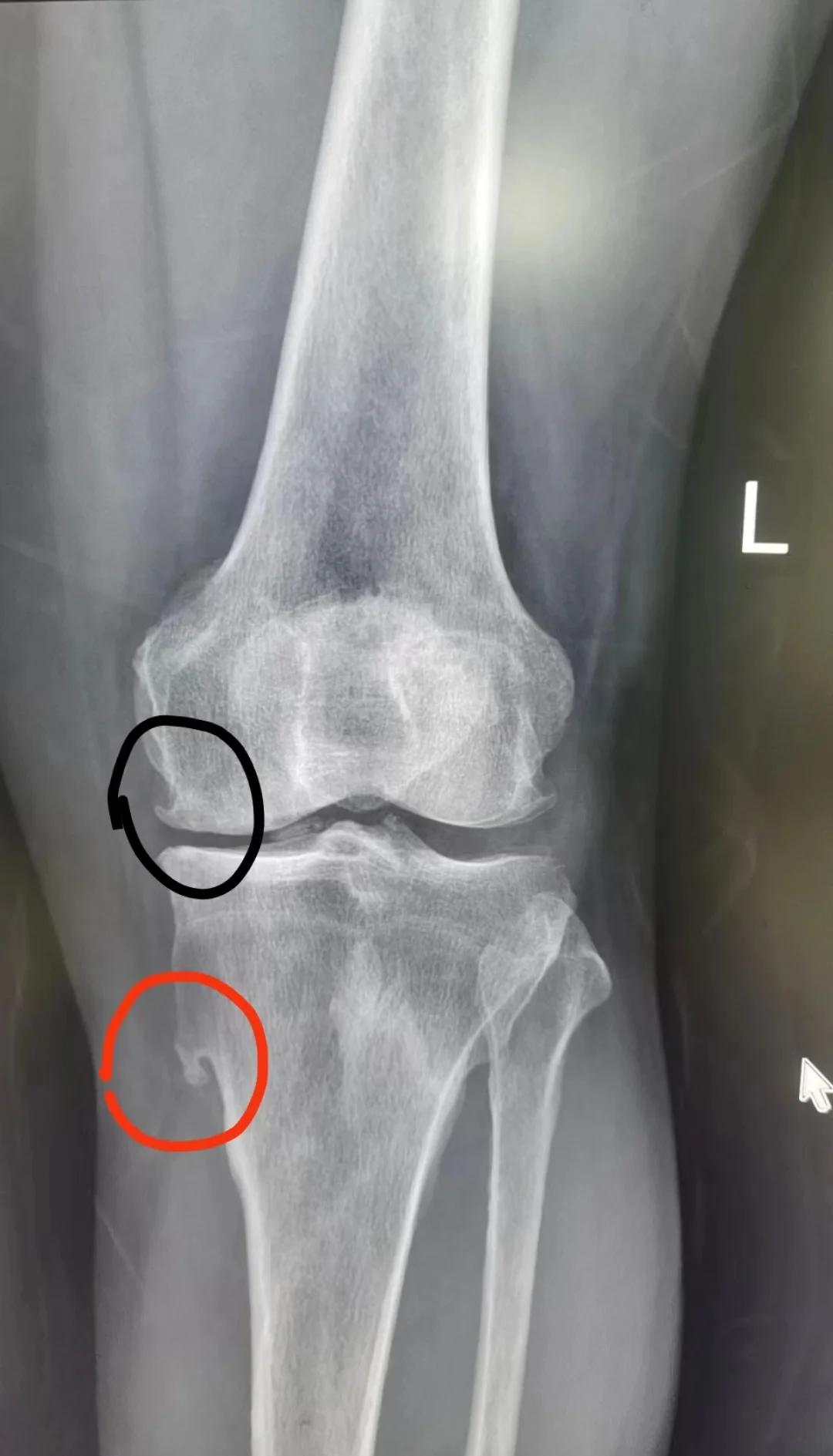 长软骨瘤正常严重吗.