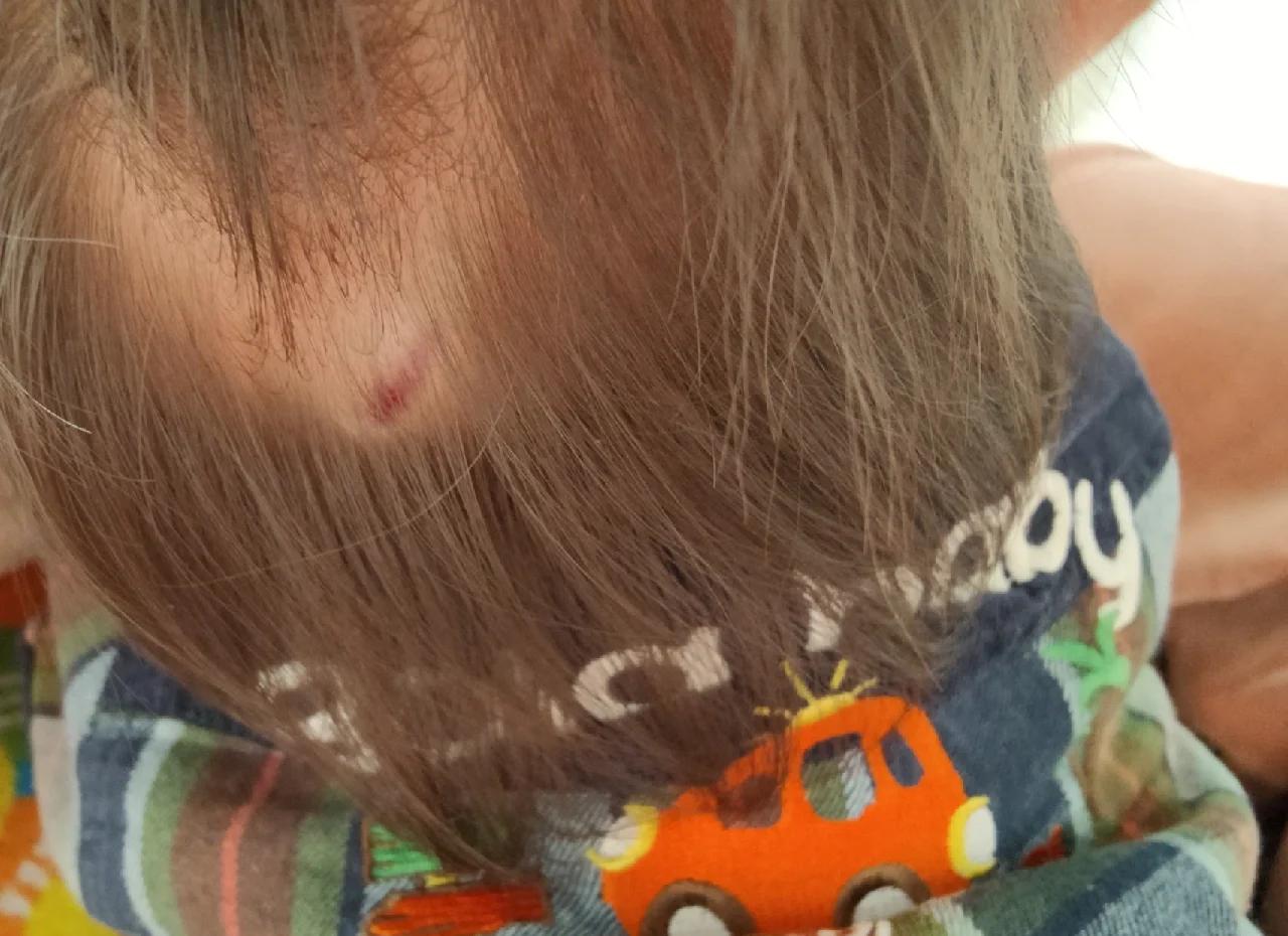 宝宝后脑勺有个小疙瘩.