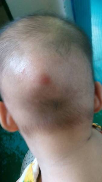 宝宝后脑勺有个小疙瘩.