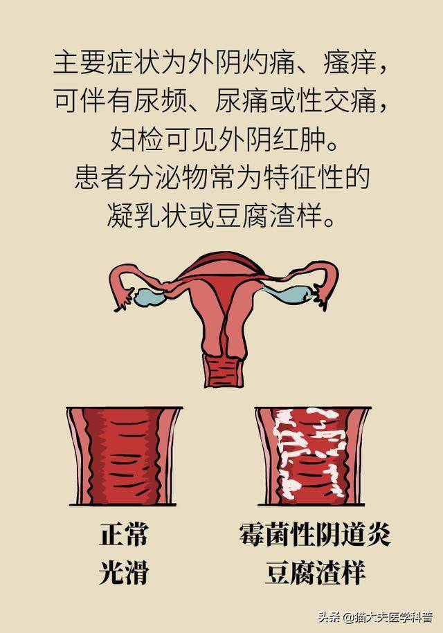 霉菌性阴道炎是什么原因造成的