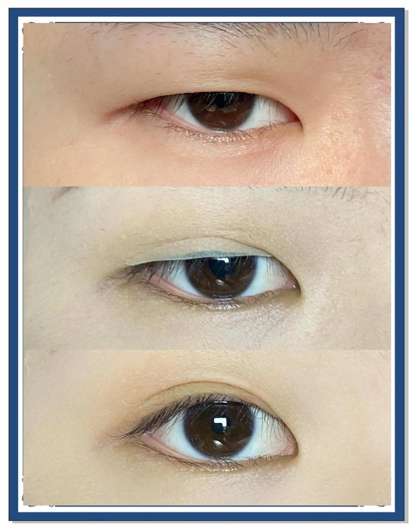 拉双眼皮的方法?