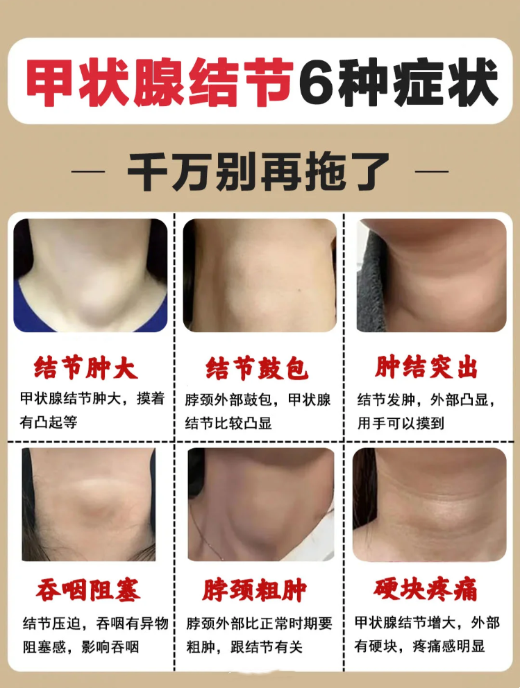 甲状腺肿大怎么分级