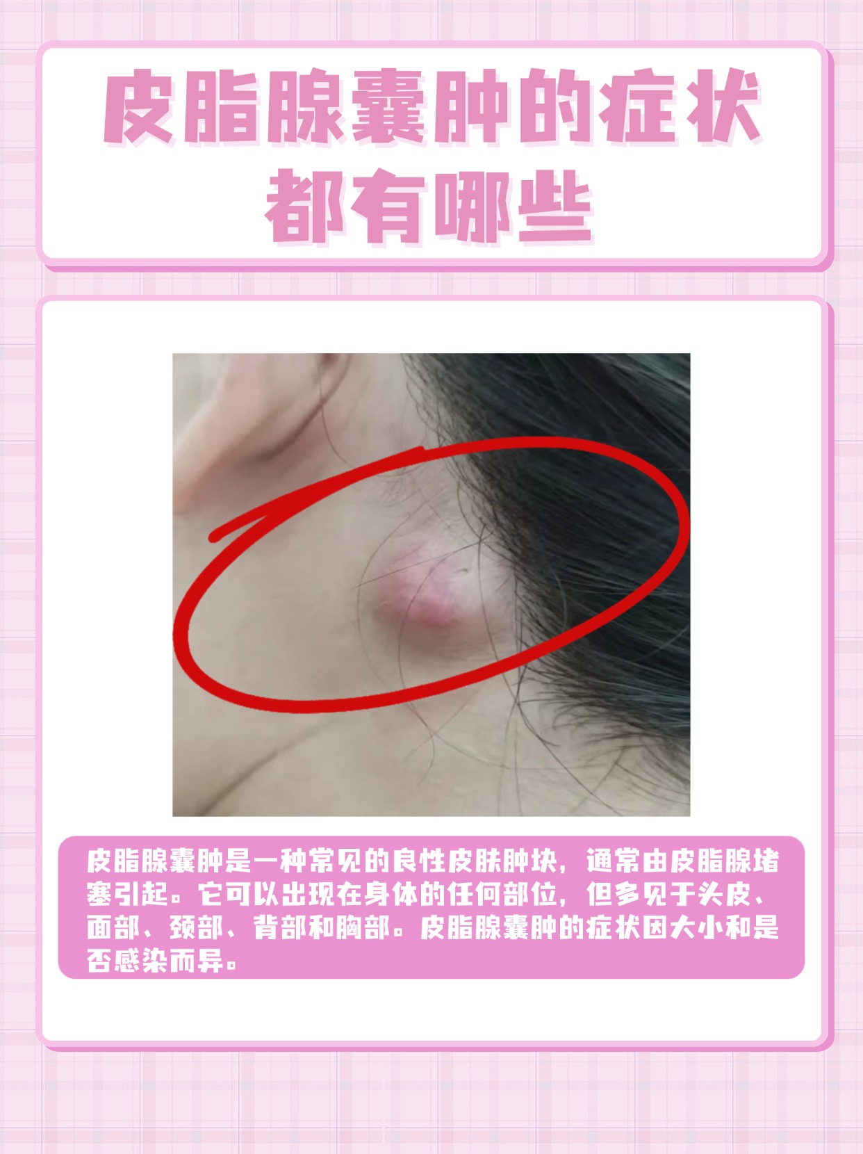 脂肪瘤怎么形成的