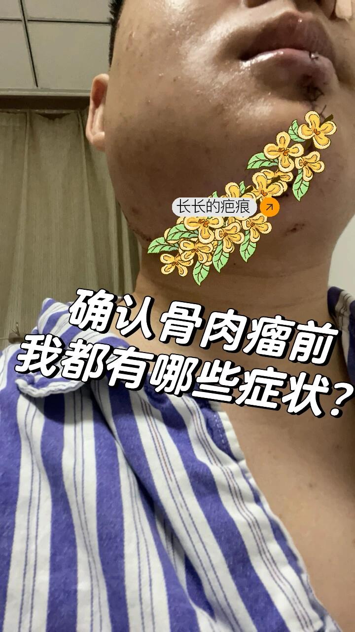 骨肉瘤的6个早期信号