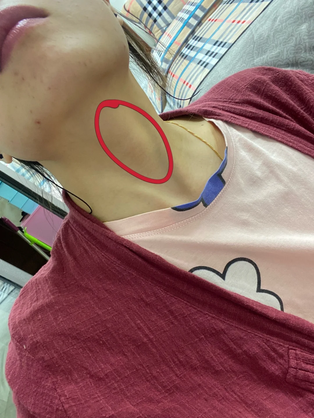 喉结左下方长了一个疙瘩