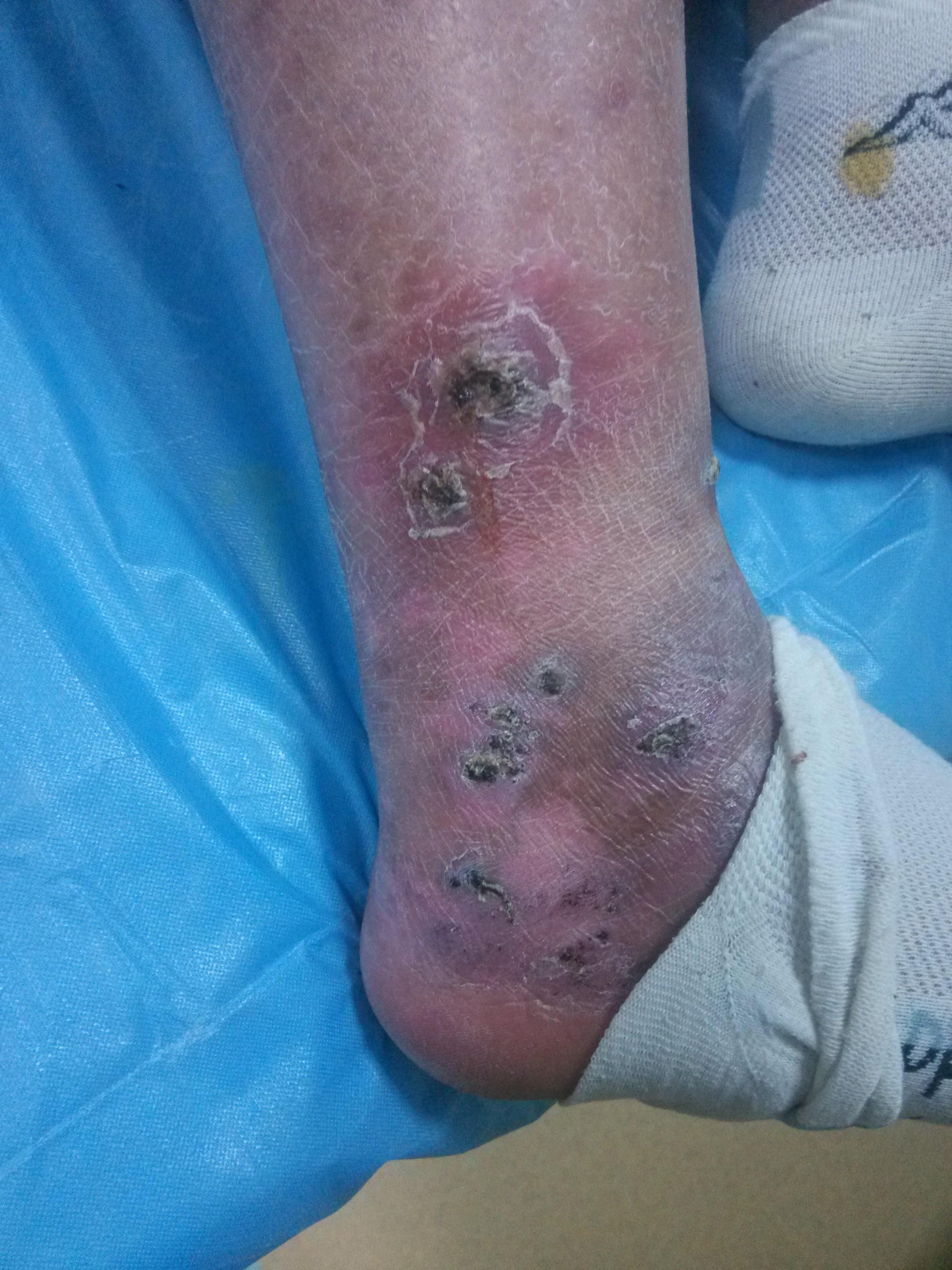 静脉炎都有哪些症状表现