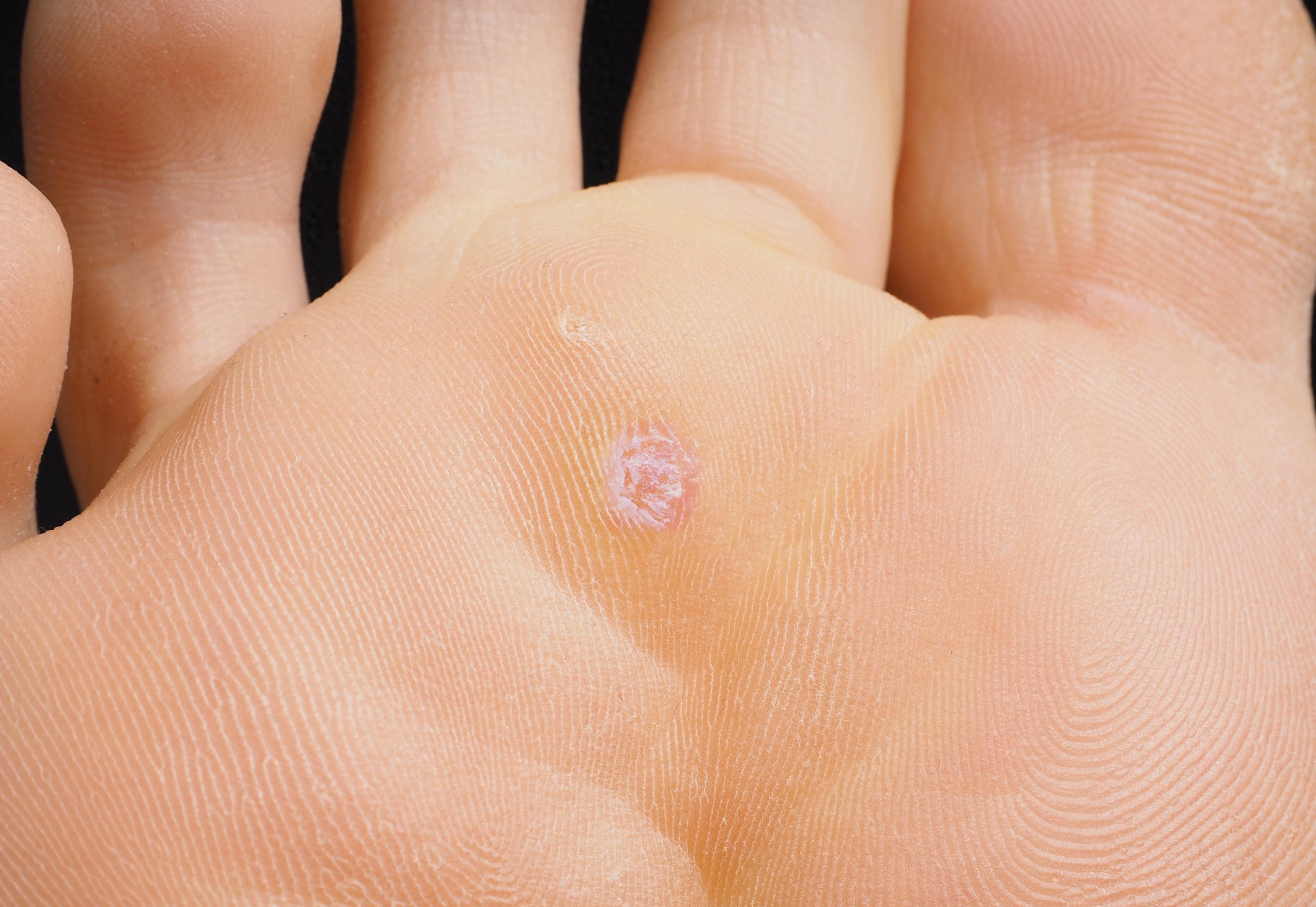 这是鸡眼吗!脚掌有很多小洞眼