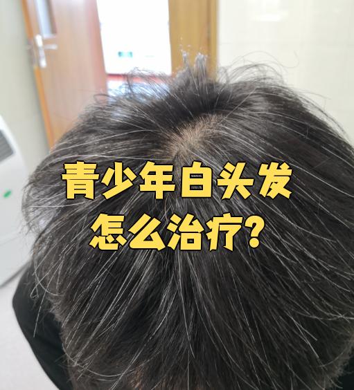 少白头怎么办