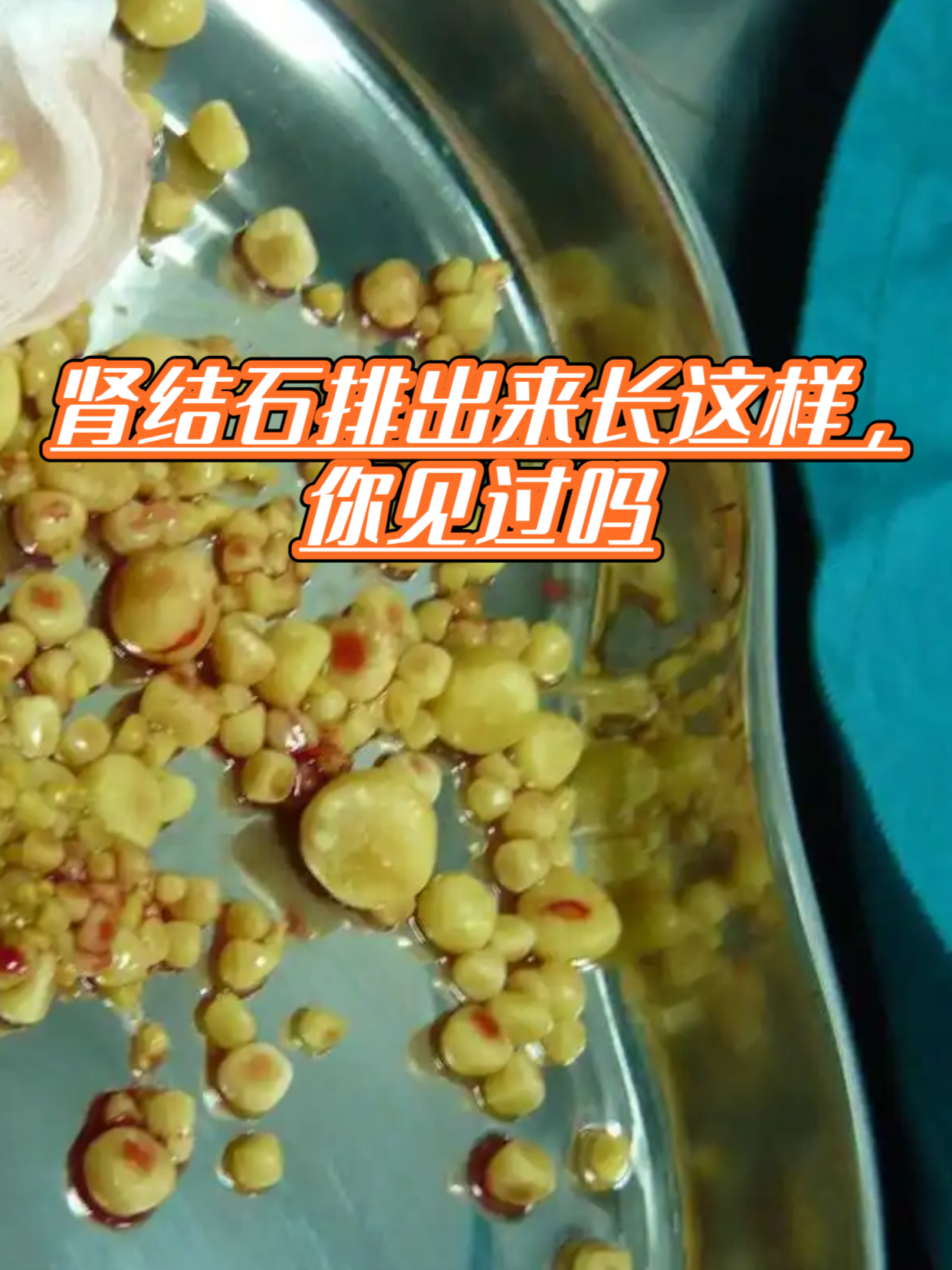 肾结石怎么排出去