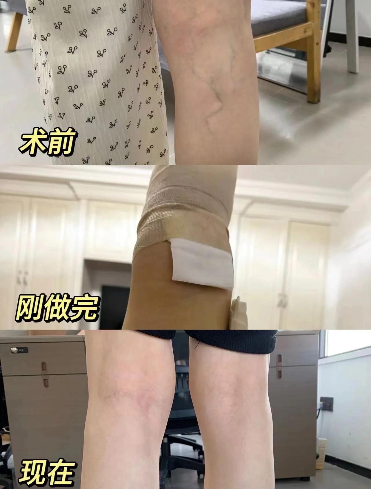 静脉曲张手术后在恢复期的症状