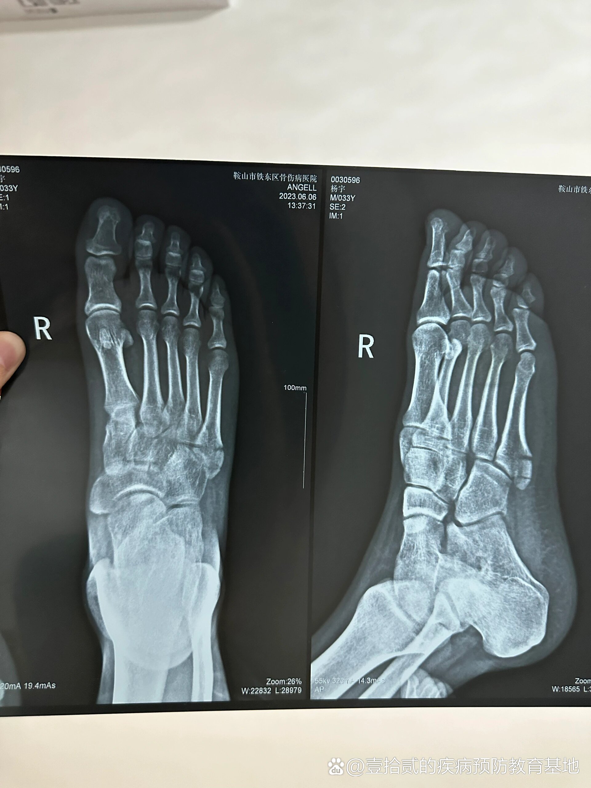 脚趾骨折症状有哪些