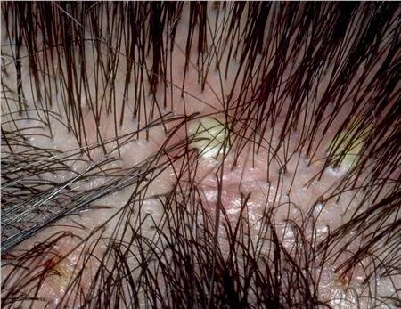 头皮毛囊炎能自愈吗?