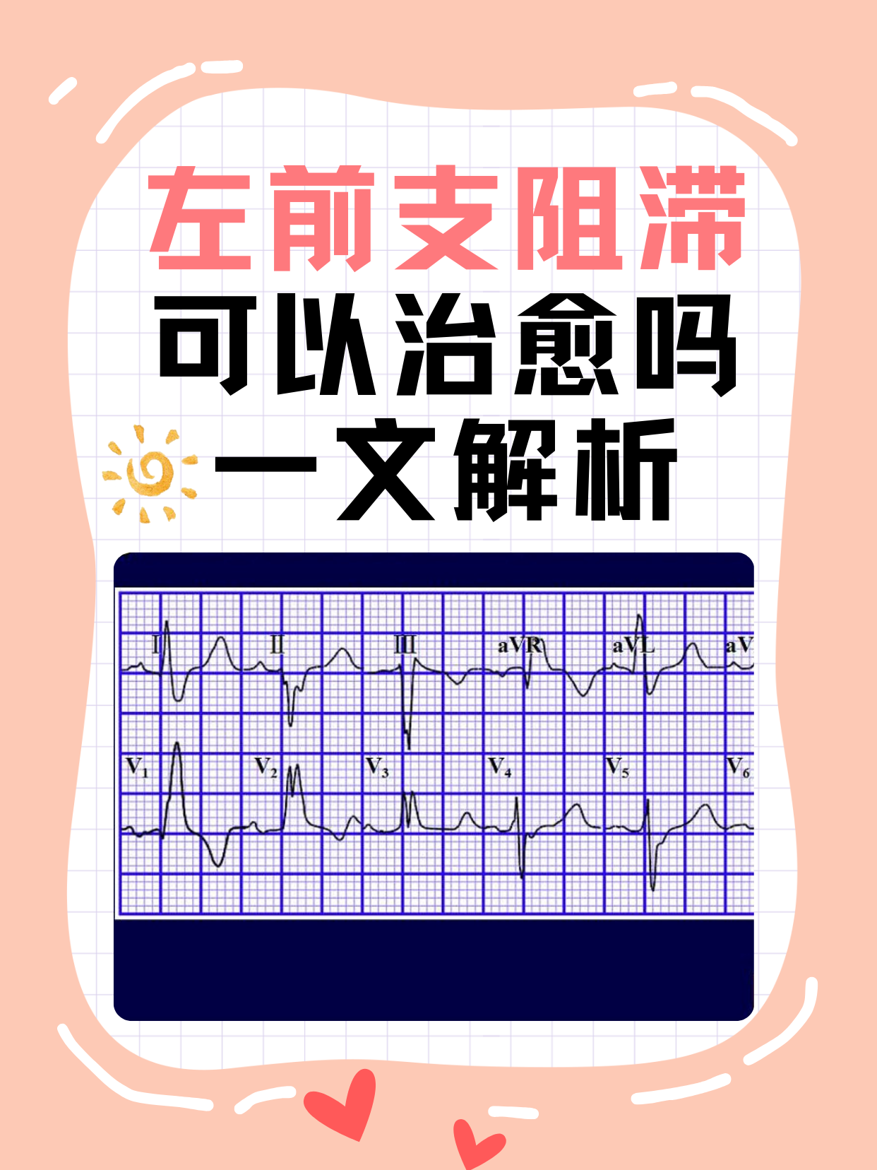 完全性左束支传导阻滞很危险吗