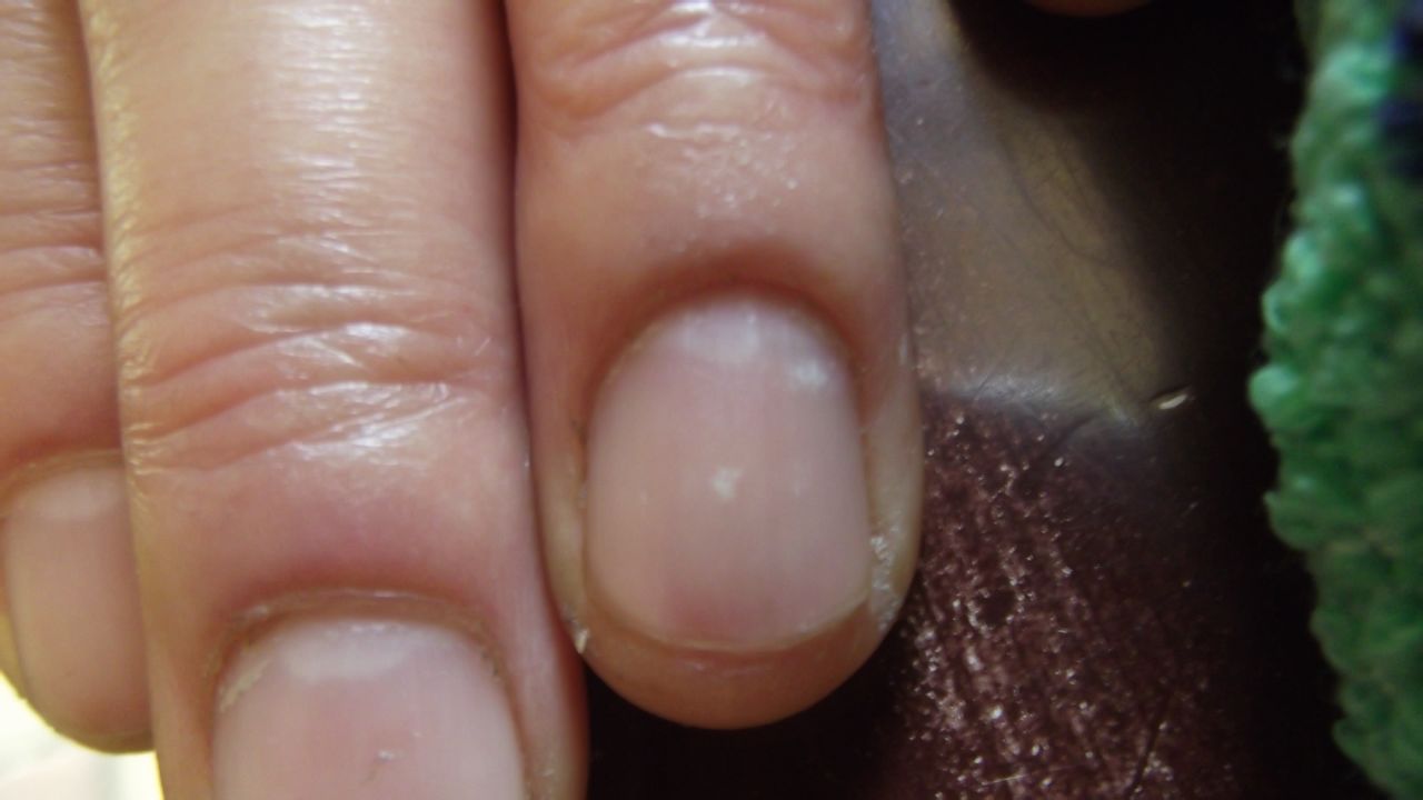 手指甲里面有白点点.