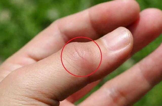 腱鞘炎有什么症状?