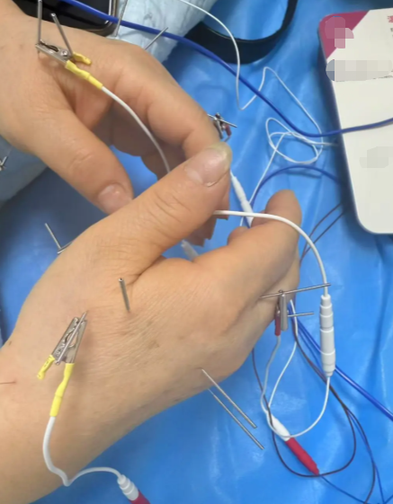 雷诺综合征的特征