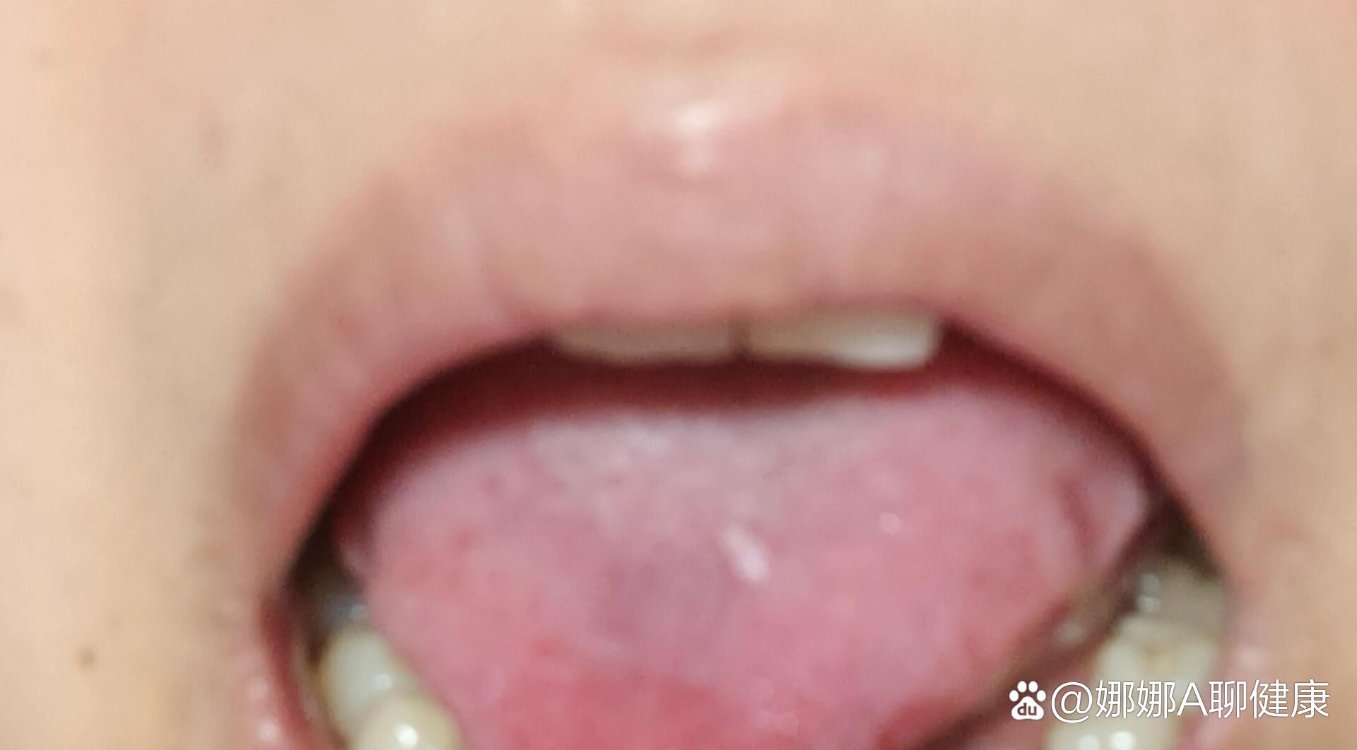 舌头上长了个肉疙瘩