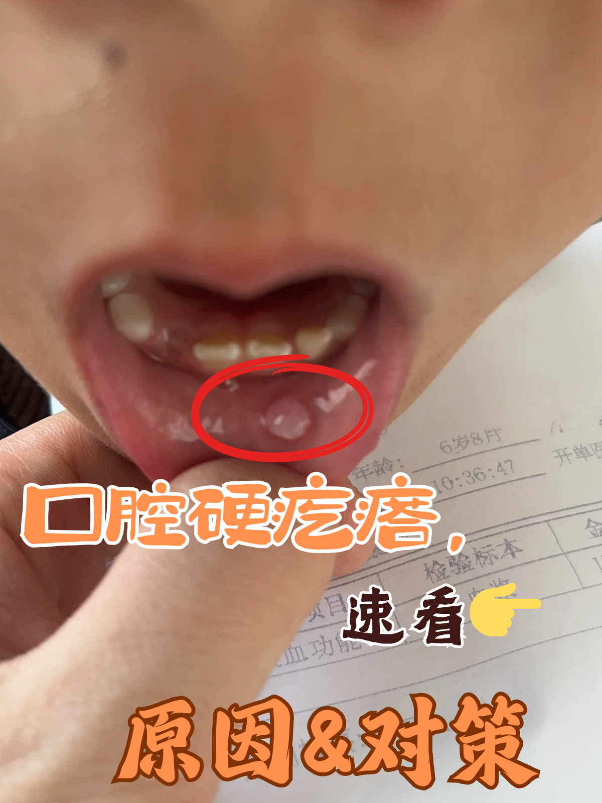 舌头上长了个肉疙瘩