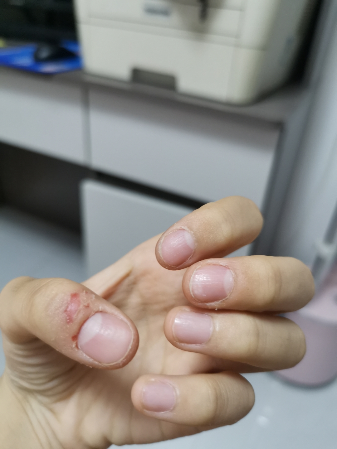 孩子手上长了很多小水泡