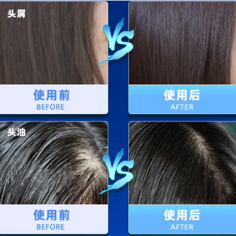 怎样治疗头皮屑