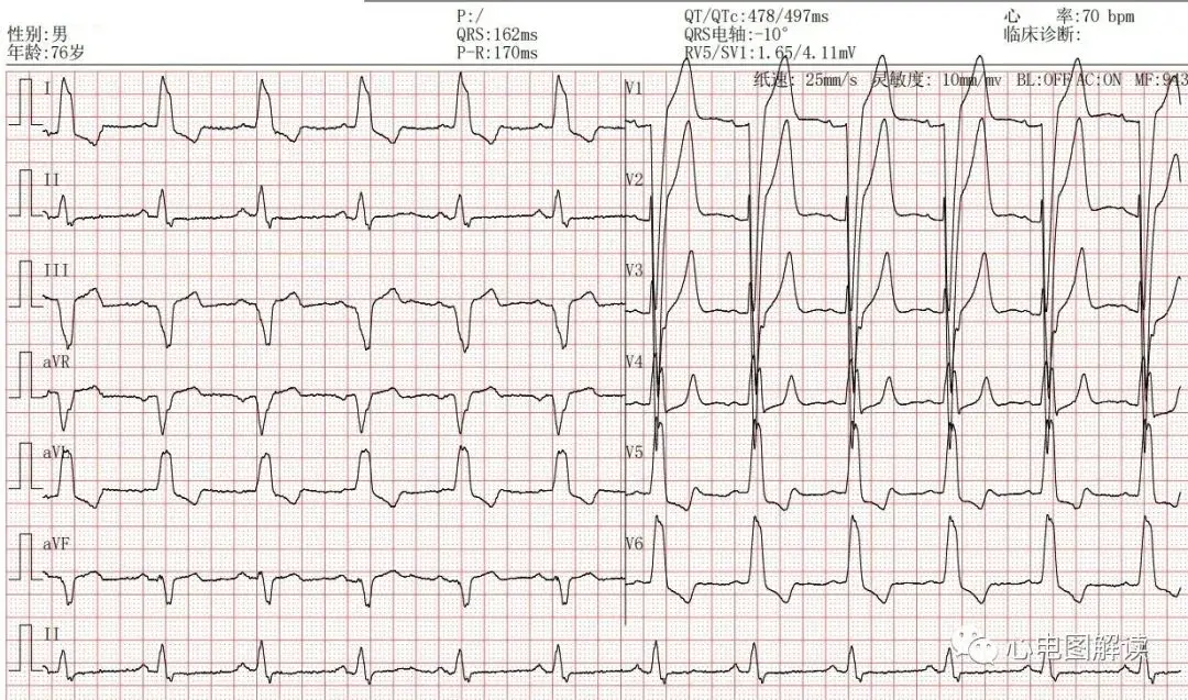 异常q波是什么意思,严重不严重