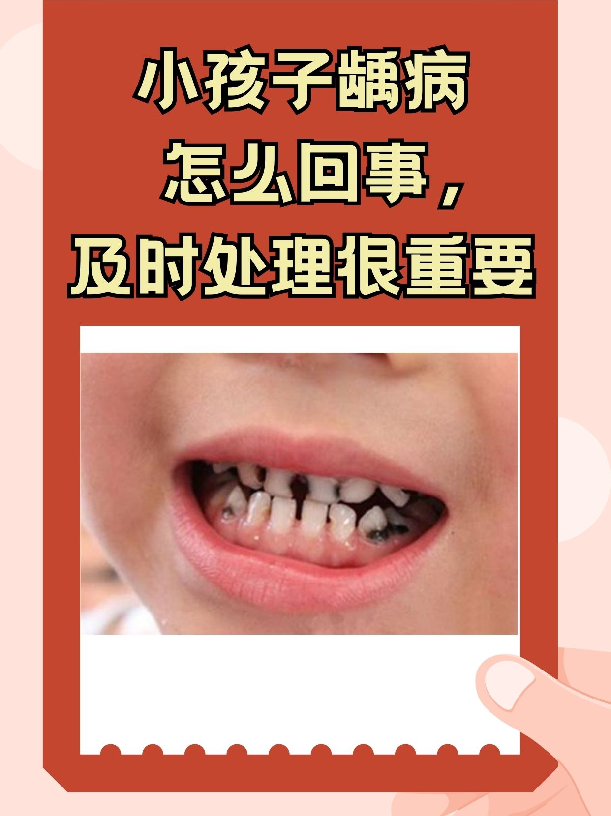 门牙蛀牙了怎么办