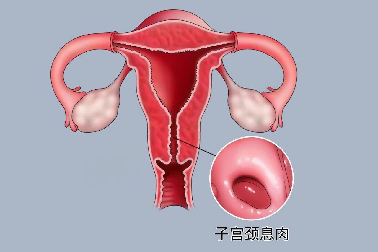 宫颈息肉能癌变吗