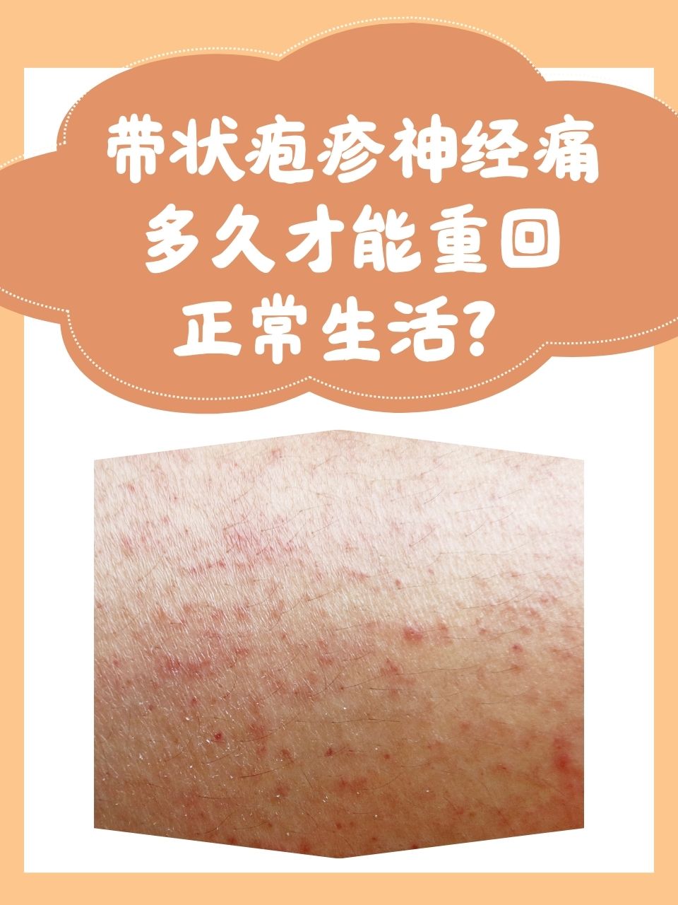 带状疱疹可以自愈吗?