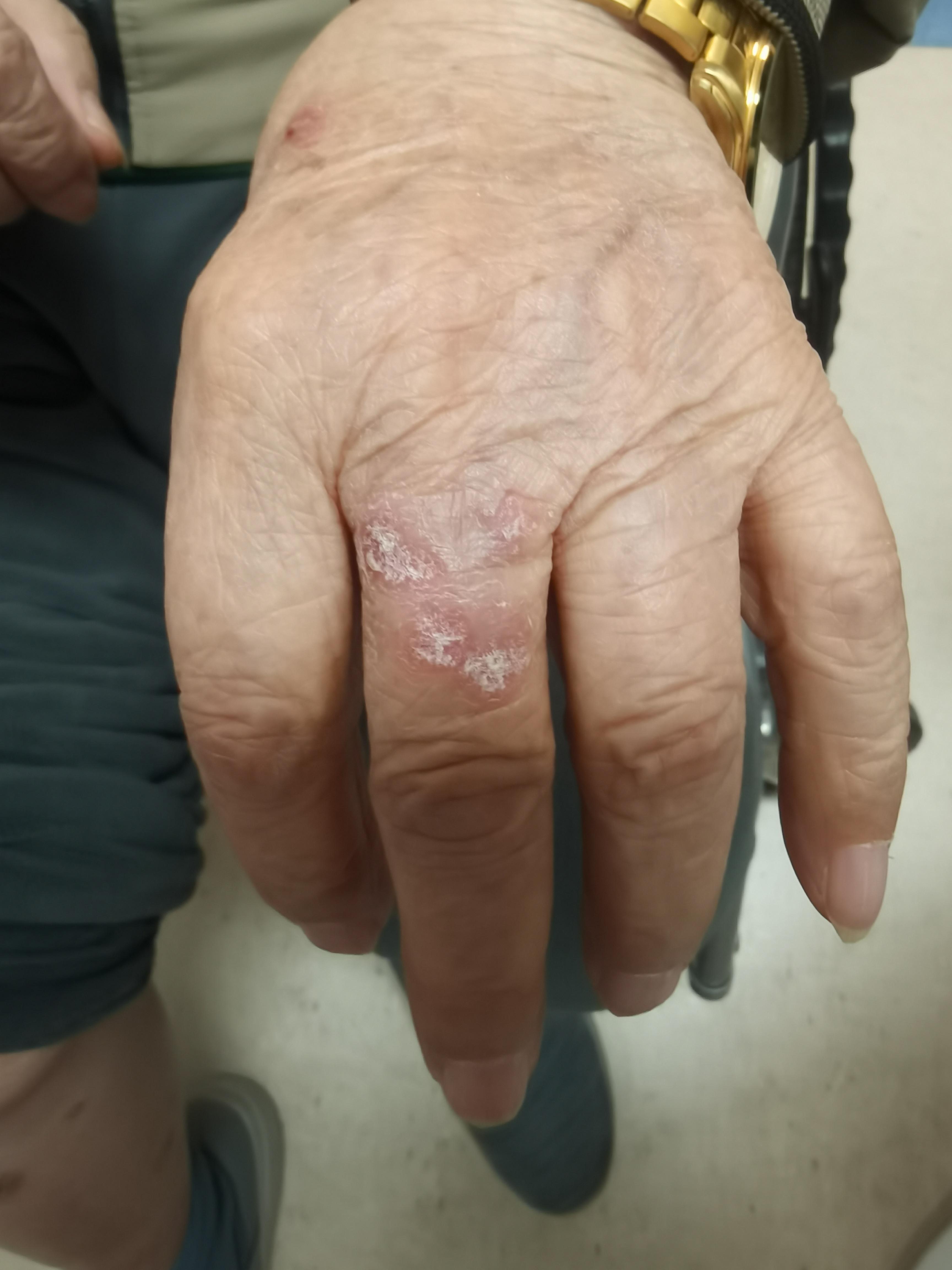 银屑病初期症状是怎么样的