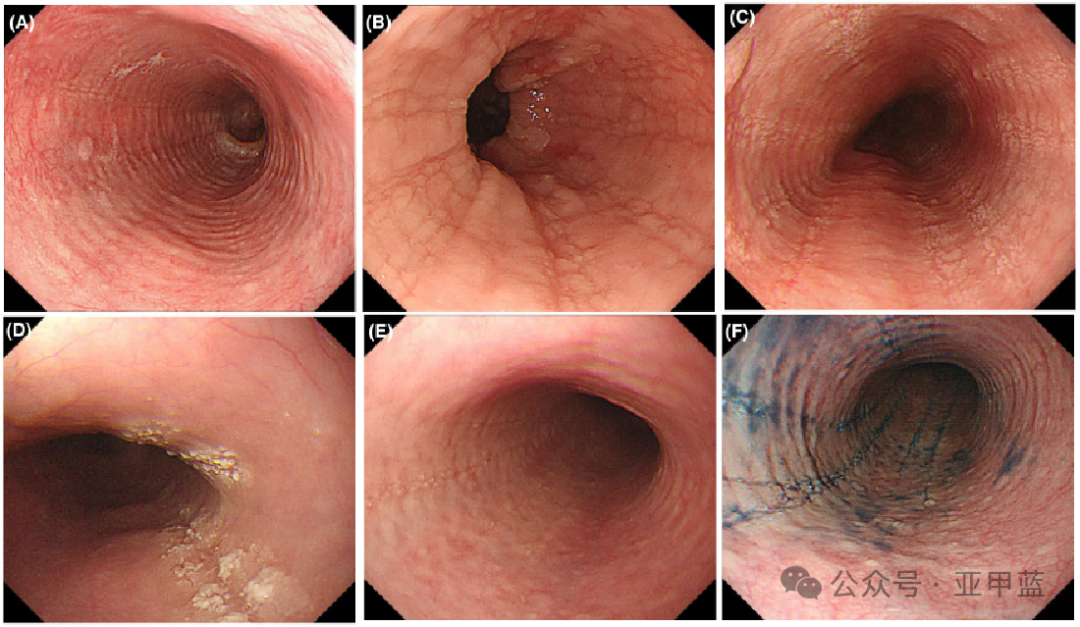 食管炎有哪些症状?