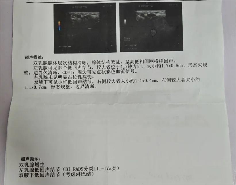 乳腺4a良性还是恶性大