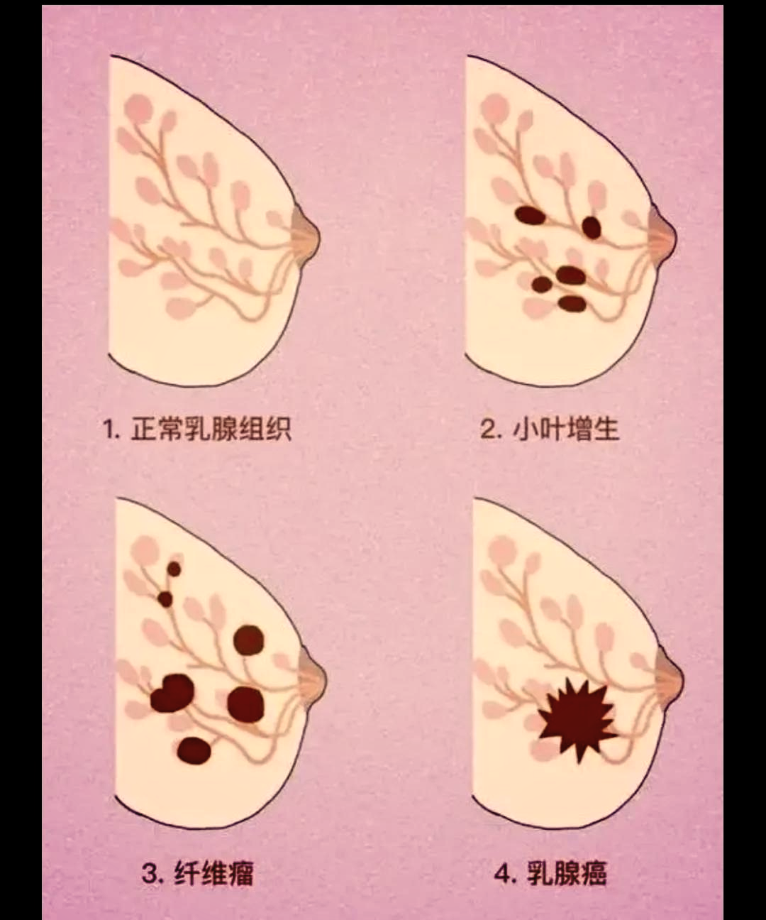 乳腺4a良性还是恶性大