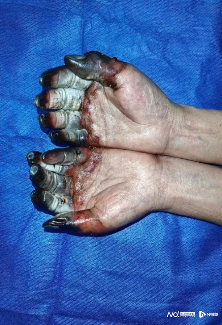 冻疮的症状图片是怎么样的