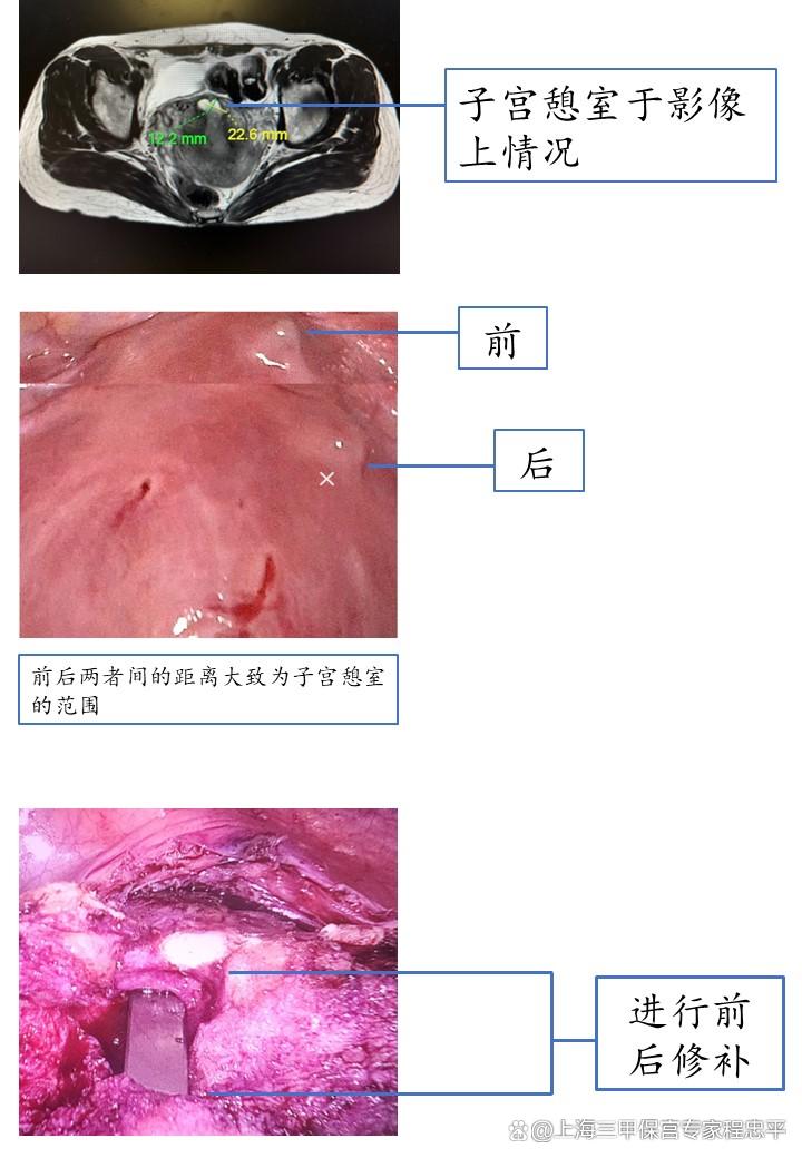 子宫憩室的最严重症状事什么