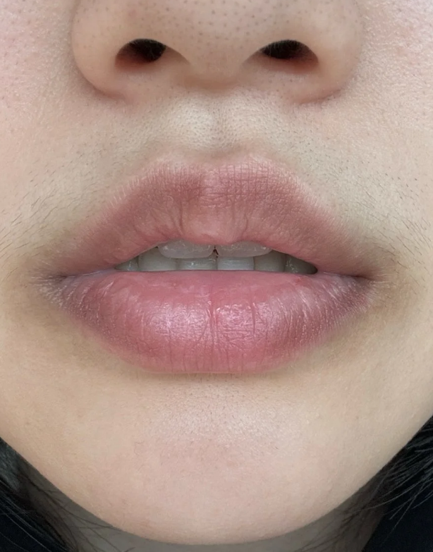 嘴唇发黑,黑色素沉积