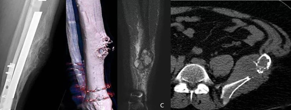 多发性骨髓瘤症状是什么