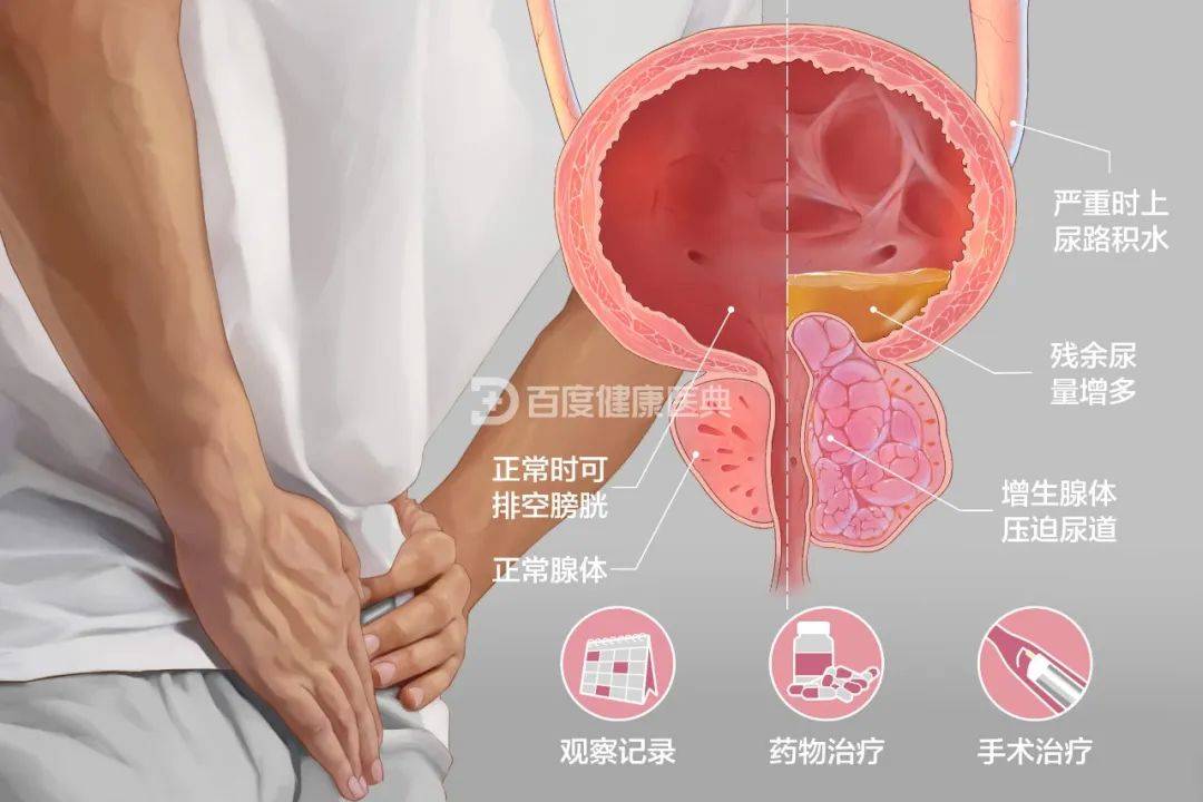 前列腺增生是怎样形成的?