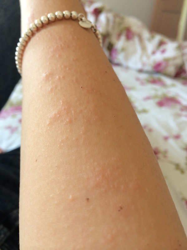 手臂长有小粒粒