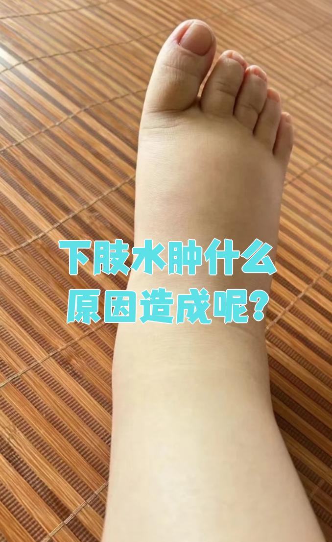 女士腿肿是怎么回事啊?