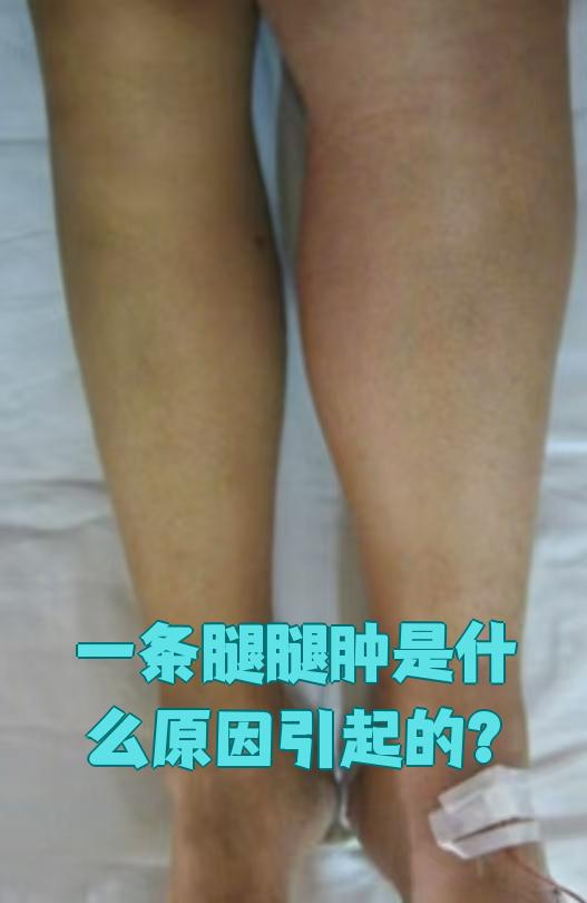 女士腿肿是怎么回事啊?