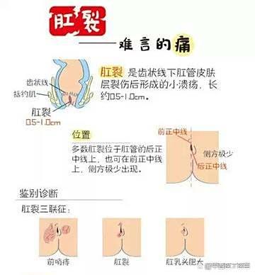 混合痔的最佳治疗方法