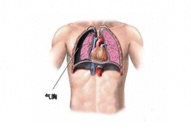 胸腔积液闭式引流位置