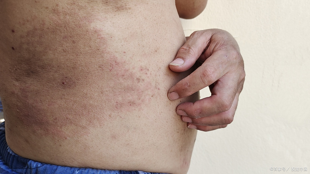 麻疹的并发症有哪些