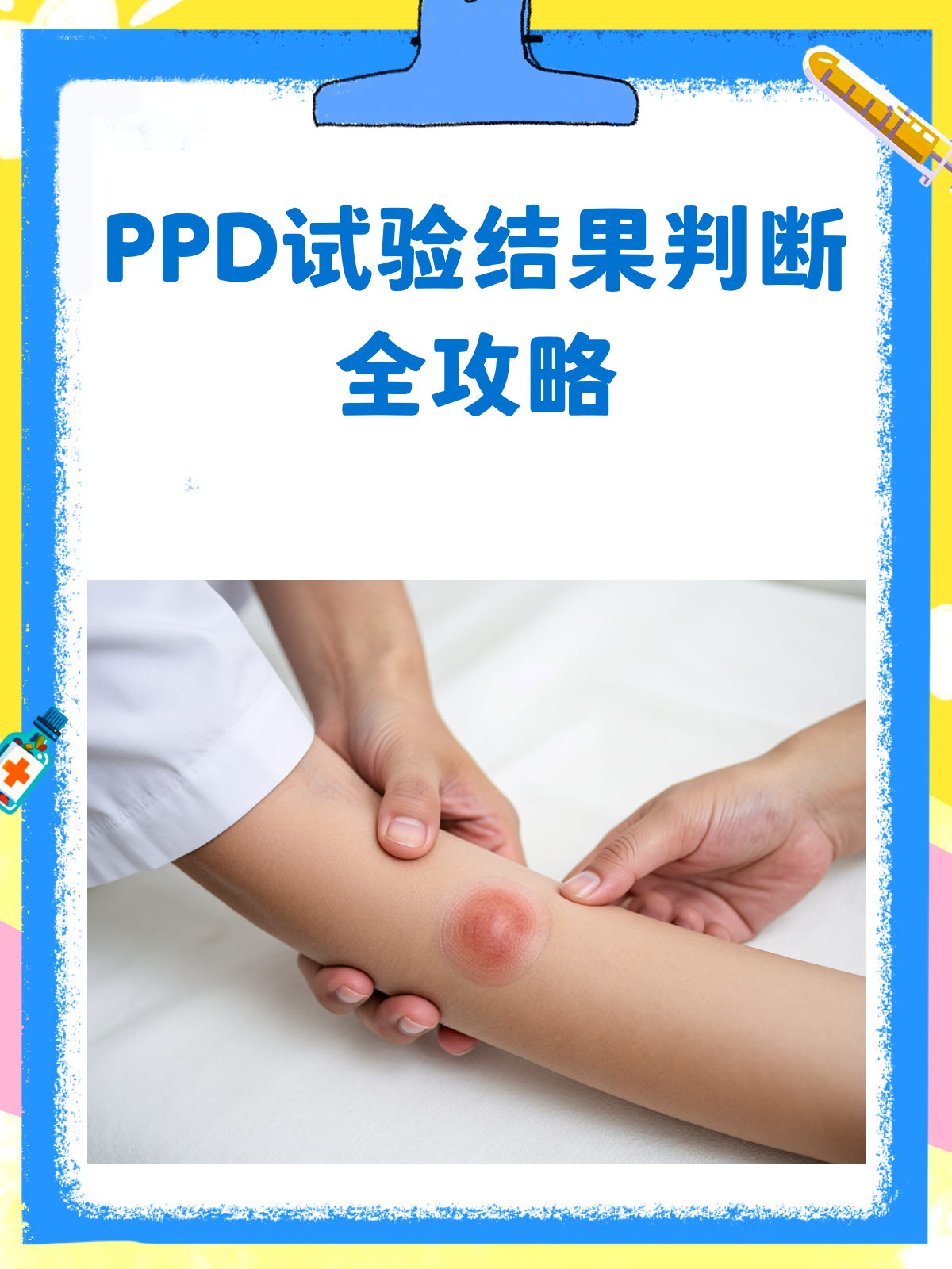 PPD试验阳性