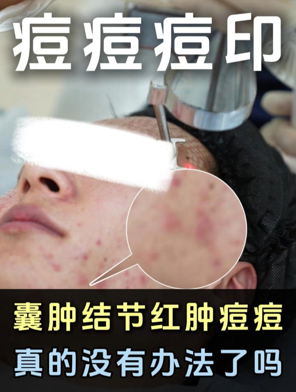 囊肿型痤疮怎么治疗