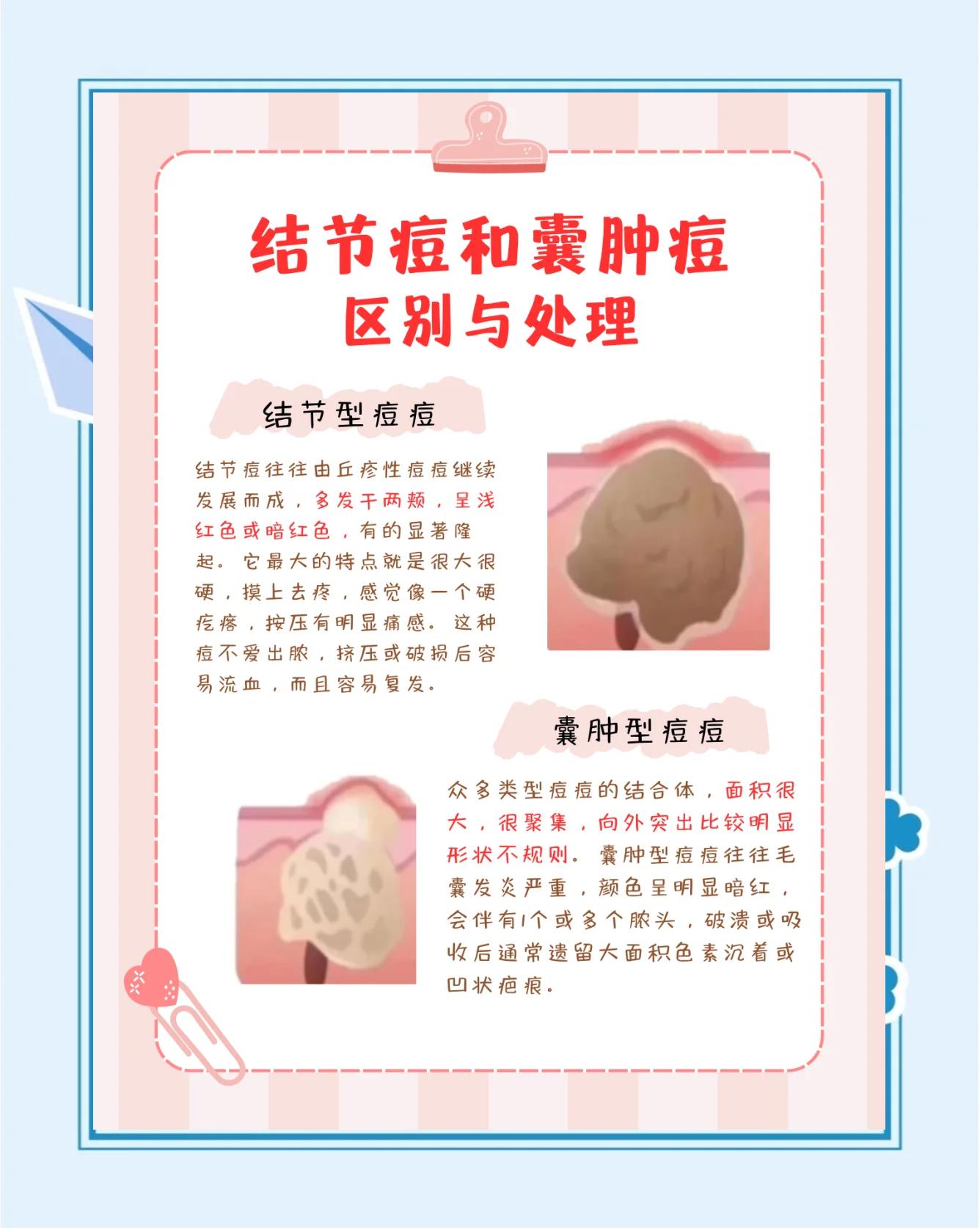 囊肿型痤疮怎么治疗