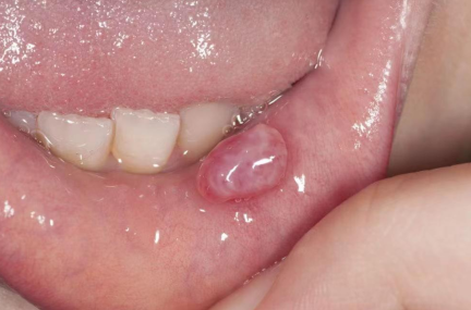 宝宝嘴里长了白色的东西