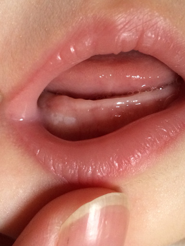 宝宝嘴里长了白色的东西