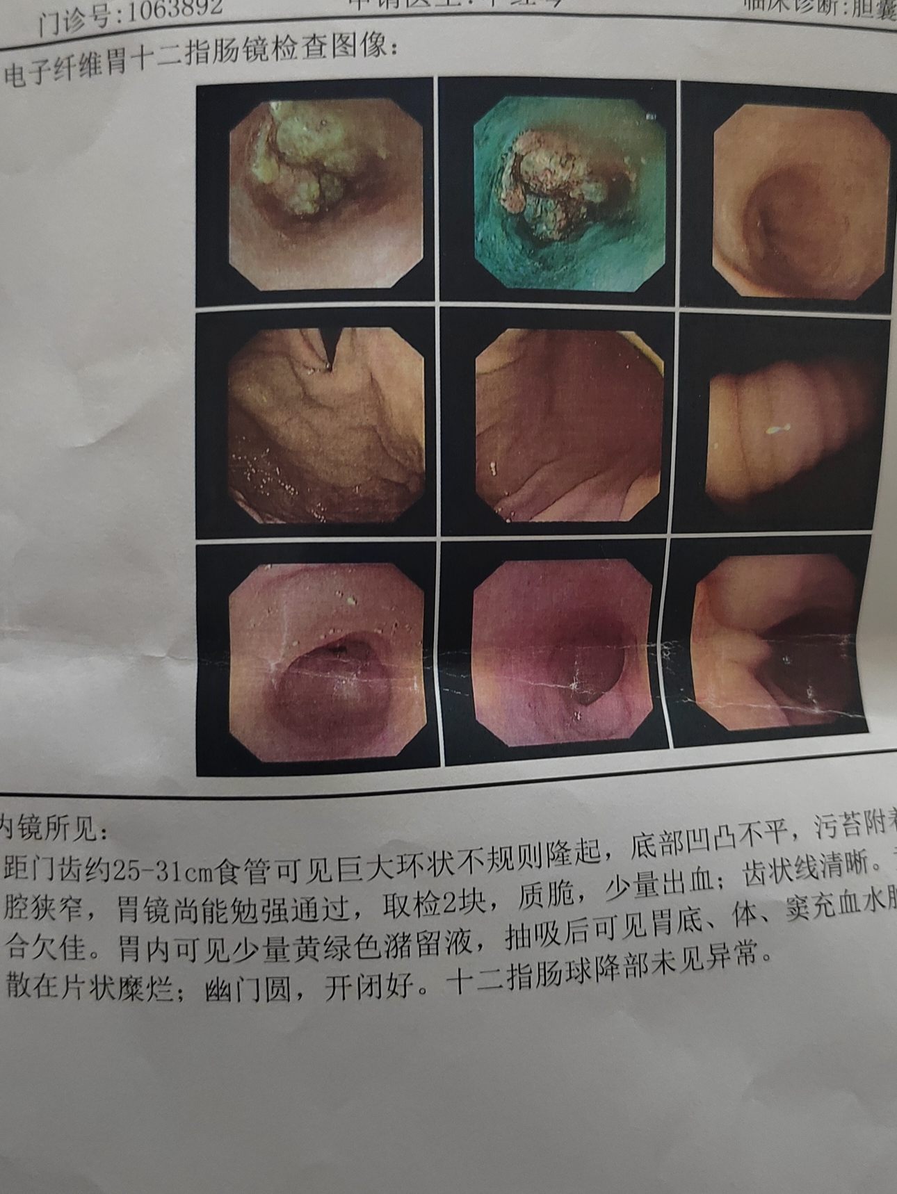 食道癌的中期症状有哪些?